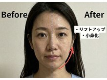 ニュートラル 渋谷店(NEUTRAL)/半顔矯正【小顔矯正】