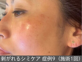 オアシスラグーン(OASIS LAGOON)/シミケア(症例9 施術1回)40代