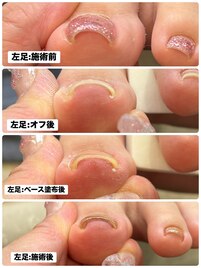 巻き爪ケア♪ペディバランス