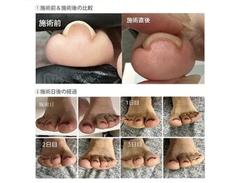 ケージェー(KJ)の写真/7月スタート!巻き爪で悩まれてる方必見! 導入キャンペーン♪通常7500円→6500円!巻き爪フットワンカラー