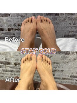 ステイゴールド 新百合ヶ丘(STAY GOLD)/足脱毛には、甲や指も含みます
