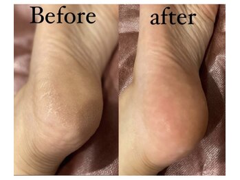 アリウム(Allium)/角質ケア＋足裏マッサージ