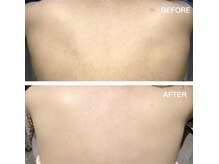 バニラ 名古屋大曽根(Vanilla)/ワックス脱毛《ボディ》