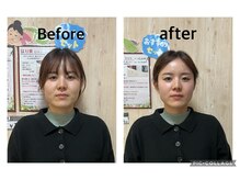 まごころ整骨院/百美鍼Before&After(１回施術）