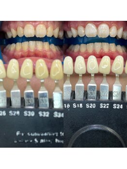 トウキョウスワーズ 池袋店(TOKYO SWRS)/#ホワイトニング #池袋 #渋谷