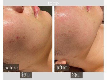 サロントット(salon totto)/before→after　肌荒れ