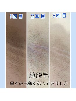 ミアローザ(Mia Rosa)/部分脱毛