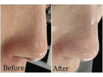 ウルト(ULT)/毛穴洗浄のBeforeAfter