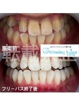 ホワイトニングサロン 福岡天神店/ホワイトニング