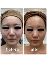 レイビス 郡山店(RAYVIS)/韓国発☆小顔コルギで歪みケア