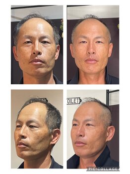 フェザー(Feather)/美容整骨お顔＋身体3回の変化♪