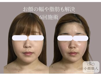 小顔職人/ 小顔ビフォーアフター/20代
