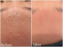 サロンドフェイス(Salon de Faith)/ハーブピーリング