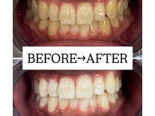 ホワイトニングサロン 宝塚/Before&After美白ホワイトニング