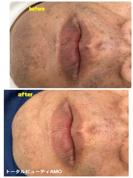 アモ(amo)/髭脱毛ビフォーアフター