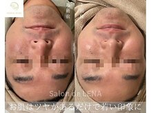 サロンドレナ 名駅店/ハーブピーリング サロンドレナ