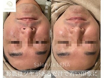 サロンドレナ 名駅店/ハーブピーリング サロンドレナ