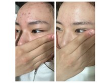 ベル(BELL)の雰囲気（毛穴レス/ハーブピーリング/肌質改善/新宿/毛穴洗浄/肌荒れ）