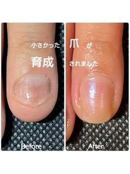 シッカネイル(sicca nail)/深爪で小さい爪が