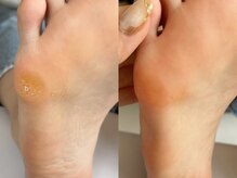 キラネイル アンド アイラッシュ by World Beauty(KIRA)/フット角質除去