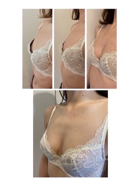 美人バスト 札幌店/バストアップ×育乳 &nbsp;◇症例◇
