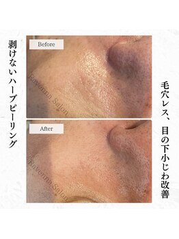 ラヴェンナサロン 札幌店(Ravenna salon)/ハーブピーリング♪でエイジング