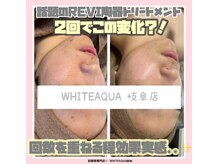 ホワイトアクア 岐阜店(WHITE AQUA)/ハーブピーリング/岐阜/毛穴