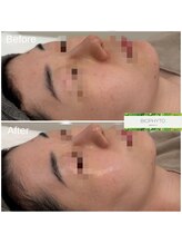 クレア(Clair)/ビオフィート症例