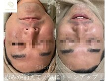 サロンドレナ 名駅店/ハーブピーリング サロンドレナ