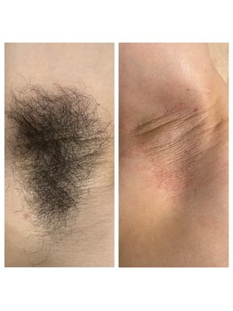 エピリア(Epilear)/メンズワキWax