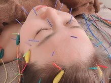 オン 蕨駅西口(ON)/美容鍼【小顔/フェイシャル】