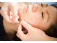 ぶんご整骨院 森院/美容鍼でリフトアップ効果も