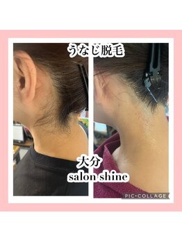 サロンシャイン(Salon Shine)/うなじ脱毛照射直後