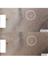 ヴェルシック(Belchic)/目立つ毛穴と凹凸にも