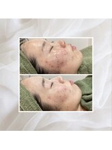 プリマプリート 名駅店/ニキビケア、毛穴撃退