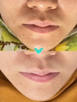 ミルキー(Milky)/マツヤニｘクレイパックで美人肌