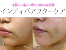 オリエンタルローザ 表参道(Oriental Rosa)/輪郭3点/ルフォー術後ケア