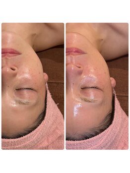 ベリンダ(BELINDA)/ラミネーションピーリング