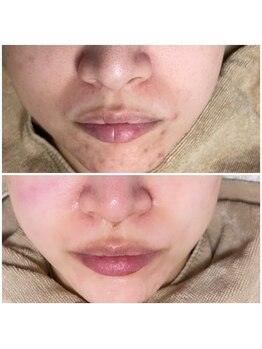 ミーミドットアイ(Mi-mi.i)/肌質改善はVOSサロンケア