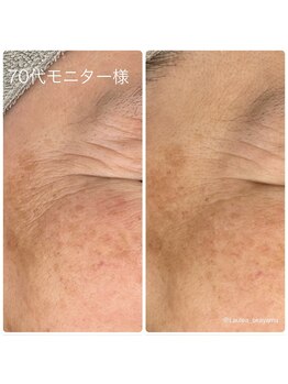 ラウレア(Laule'a)/お悩みのシワにアプローチ