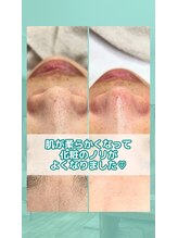 ネクサス(NEXUS)/【毛穴ケア】お客様の声30代女性