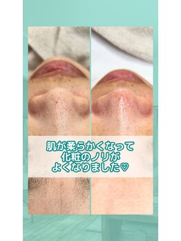 ネクサス(NEXUS)/【毛穴ケア】お客様の声30代女性