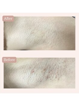 リードエピア(LEADepiA)/ワキ脱毛のビフォーアフター