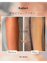 ラディアント(Radiant)/肘下脱毛