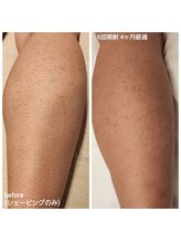 ルオント(LUONTO)/メンズ脚脱毛 効果