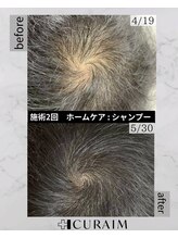 クリスタルグロウ 苫小牧大町店(Crystal Glow)/CURAIM育毛促進施術