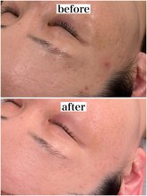 シェアサロン レノール(SHARE SALON LENORL)/【プラズマニア】ニキビケア症例