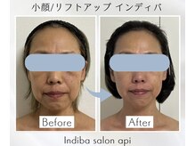 アピ(api)/症例写真【小顔インディバ】