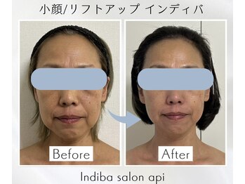 アピ(api)/症例写真【小顔インディバ】