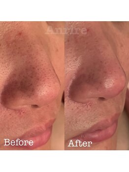 アンリール/毛穴エクストラクション